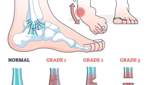 My ankle sprain is healing.